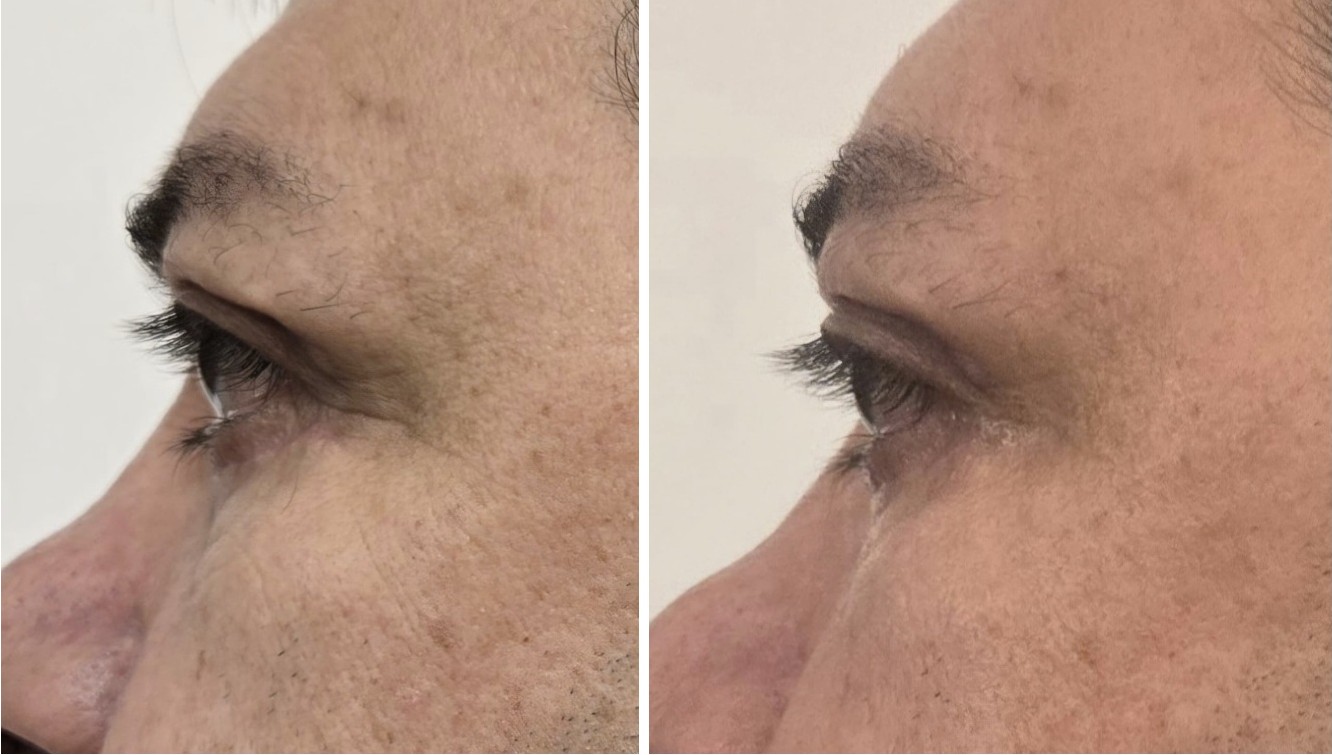 Reducción de arrugas de expresión zona ocular — antes y después, vista perfil