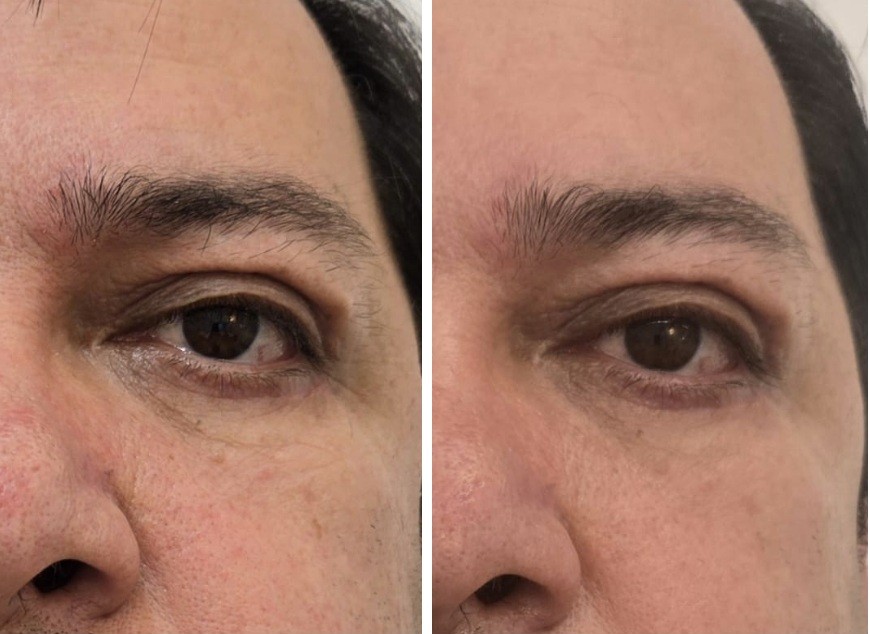 Reducción de arrugas de expresión zona ocular — antes y después, vista frontal
